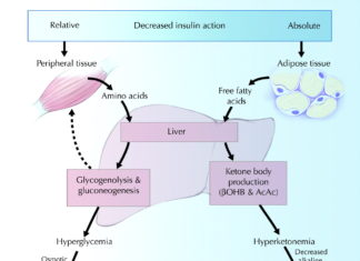 Type 1 diabetes : Diabetic Ketoacidosis (DKA) – an enemy always lurking