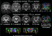 Using neuroimaging technology to examine white matter tracts in the brain, researchers were able to diagnose Alzheimer’s disease with 95% accuracy