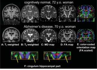 Using neuroimaging technology to examine white matter tracts in the brain, researchers were able to diagnose Alzheimer’s disease with 95% accuracy