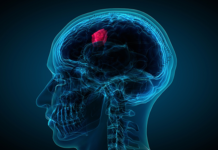 Scientists are making strides in developing liquid biopsies for brain tumours by detecting tumour DNA in the fluid from around the brain and spine
