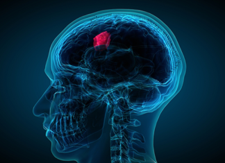 Scientists are making strides in developing liquid biopsies for brain tumours by detecting tumour DNA in the fluid from around the brain and spine