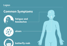 Lupus – What is and what you should know