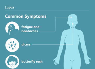 Lupus – What is and what you should know