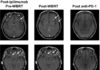 When melanoma turns metastatic, it spreads to the brain in more than 40% of patients – checkpoint inhibitor immunotherapy drug has meaningful benefit for these patients