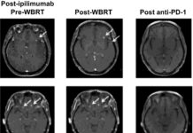 When melanoma turns metastatic, it spreads to the brain in more than 40% of patients – checkpoint inhibitor immunotherapy drug has meaningful benefit for these patients
