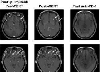 When melanoma turns metastatic, it spreads to the brain in more than 40% of patients – checkpoint inhibitor immunotherapy drug has meaningful benefit for these patients