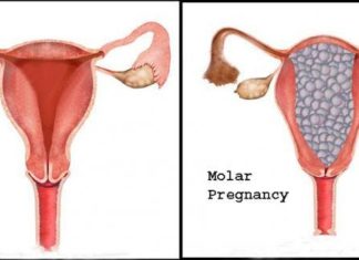 A team of scientists identified three genes responsible for recurrent molar pregnancies