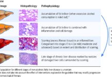 Researchers have made a discovery about how disease pathogenesis in the liver is regulated – nonalcoholic fatty liver disease (NAFLD)