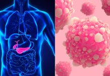 New research has linked adolescent obesity with up to a four-fold increased risk of pancreatic cancer later in life