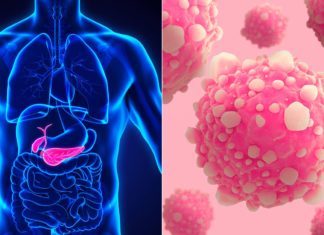 New research has linked adolescent obesity with up to a four-fold increased risk of pancreatic cancer later in life