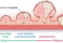 Both aspirin and a purified omega-3 reduce the number of pre-cancerous polyps in patients found to be at high risk of developing bowel cancer