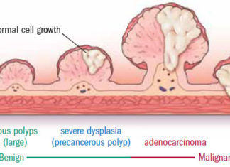 Both aspirin and a purified omega-3 reduce the number of pre-cancerous polyps in patients found to be at high risk of developing bowel cancer