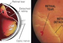 A minimally invasive treatment for retinal detachment gives patients sharper vision, less distortion and reduced side-effects