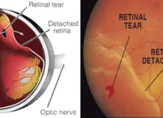 A minimally invasive treatment for retinal detachment gives patients sharper vision, less distortion and reduced side-effects