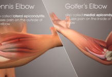 Researchers have compared the efficacy and safety of non-surgical treatment options for tennis elbow