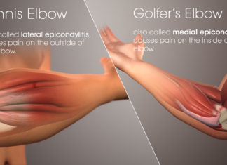 Researchers have compared the efficacy and safety of non-surgical treatment options for tennis elbow