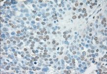Researchers find inhibiting USP13 protein destroys toxic clumps seen in Parkinson’s disease