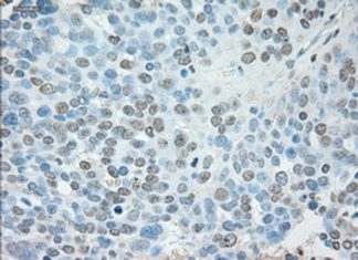Researchers find inhibiting USP13 protein destroys toxic clumps seen in Parkinson’s disease