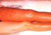 A Canadian clinical trial provides the first approach for safely preventing blood clots in people with cancer
