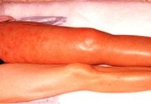 A Canadian clinical trial provides the first approach for safely preventing blood clots in people with cancer