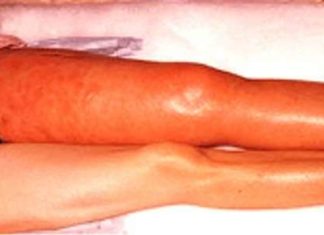 A Canadian clinical trial provides the first approach for safely preventing blood clots in people with cancer