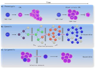 Advances in rapid screening of leukemia cells for drug susceptibility and resistance are bringing scientists closer to patient-tailored treatment for acute myeloid leukemia (AML)