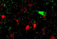 A UCLA-led research team has identified genetic processes involved in the neurodegeneration that occurs in dementia