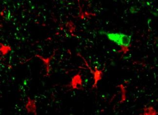 A UCLA-led research team has identified genetic processes involved in the neurodegeneration that occurs in dementia