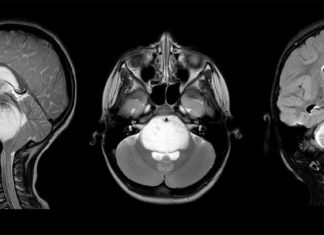 Scientists have mapped the effects of aberrant biological machinery that drives a deadly brain cancer called diffuse intrinsic pontine glioma (DIPG)