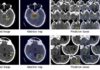 Developed a system using artificial intelligence to quickly diagnose and classify brain hemorrhages
