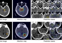 Developed a system using artificial intelligence to quickly diagnose and classify brain hemorrhages
