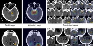 Developed a system using artificial intelligence to quickly diagnose and classify brain hemorrhages