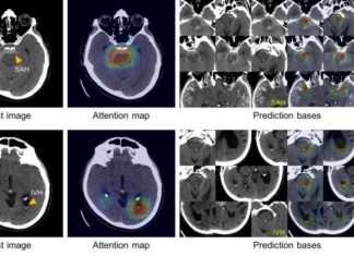 Developed a system using artificial intelligence to quickly diagnose and classify brain hemorrhages