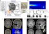 Emerging technique uses ultrasonic waves to noninvasively modulate brain activity