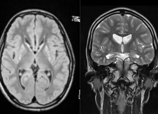 A new mechanism dubbed “neuritosis” could explain the neurons that shrink in Huntington