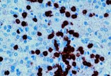 Immunotherapy has proved effective in treating a number of cancers, but brain tumors have remained stubbornly resistant