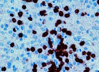 Immunotherapy has proved effective in treating a number of cancers, but brain tumors have remained stubbornly resistant