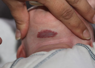 Infantile hemangiomas