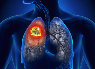 Lung Cancer : Breast cancer drugs could help