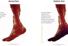 Monitoring a wound is critical in diabetic patients due to nerve damage can lead to infection of a lesion and amputation