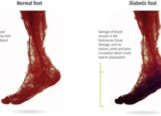 Monitoring a wound is critical in diabetic patients due to nerve damage can lead to infection of a lesion and amputation