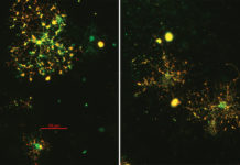 Psychotic disorders – schizophrenia – researchers investigate abnormalities in nerve connections in the brain