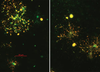 Psychotic disorders – schizophrenia – researchers investigate abnormalities in nerve connections in the brain