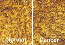 Research team developed a non-invasive method for detecting bladder cancer