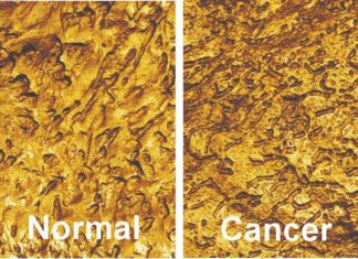 Research team developed a non-invasive method for detecting bladder cancer