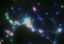 Researchers discovered that ovarian cancer cells spread to new tissue after being caught in DNA “webs” extruded by immune cells