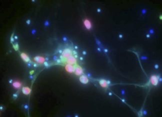Researchers discovered that ovarian cancer cells spread to new tissue after being caught in DNA “webs” extruded by immune cells