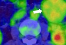 Sorafenib stopped progression of desmoid – rare connective tissue tumor