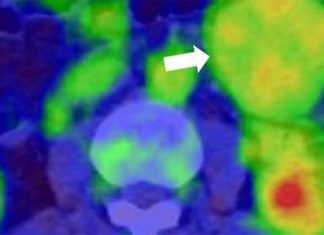Sorafenib stopped progression of desmoid – rare connective tissue tumor