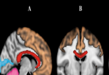 Stressful or traumatic experiences occurring in a child’s earliest years have been linked to reduced hippocampal volume in adolescence